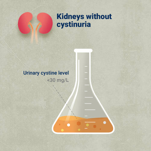 Picture of an Erlenmeyer flask containing the urine of a person who doesn’t have cystinuria showing a healthy cystine level 