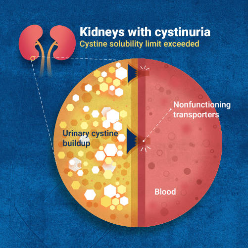 Zoomed in picture of kidneys in a person who has cystinuria showing how cystine in the urine cannot filter through broken transporters in the kidneys, leading to cystine buildup.