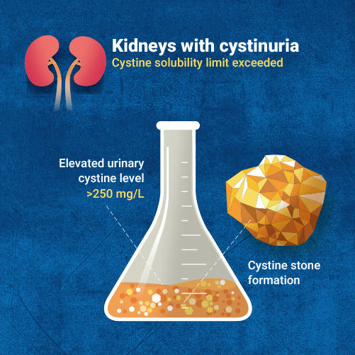 Picture of an Erlenmeyer flask containing the urine of a person who has cystinuria showing an elevated cystine level, leading to cystine stone formation